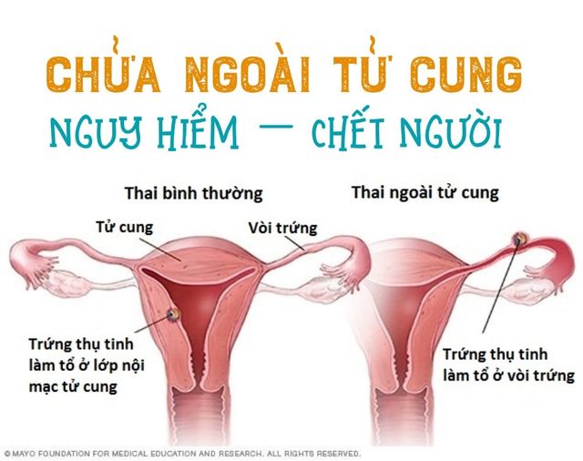 Chửa ngoài tử cung – nguy hiểm chết người